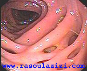 تصوير گرفته شده از داخل روده بزرگ مبتلا به بيماري دايورتيکولوزيس